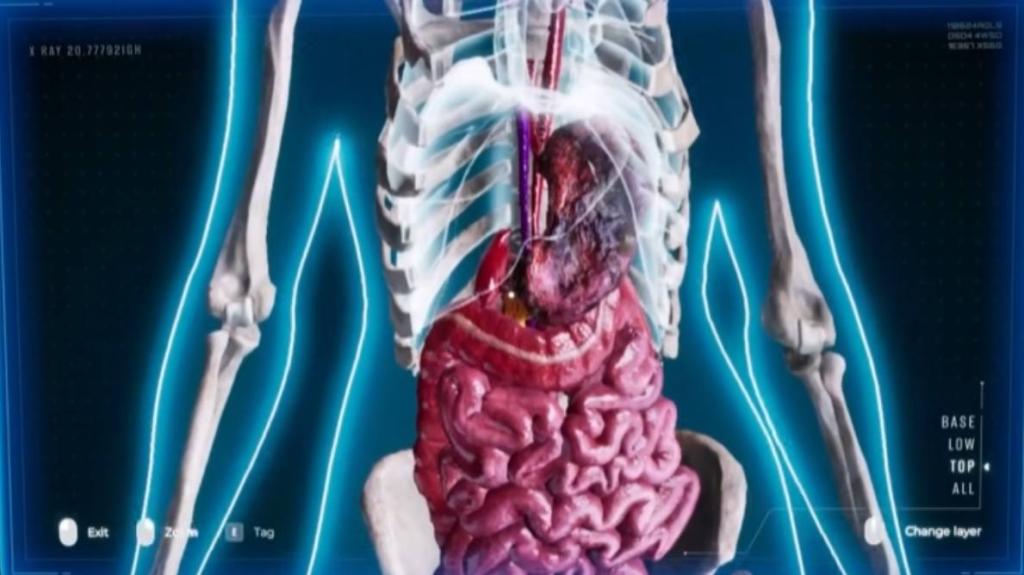 necrosis on the stomach, visible on the x-ray